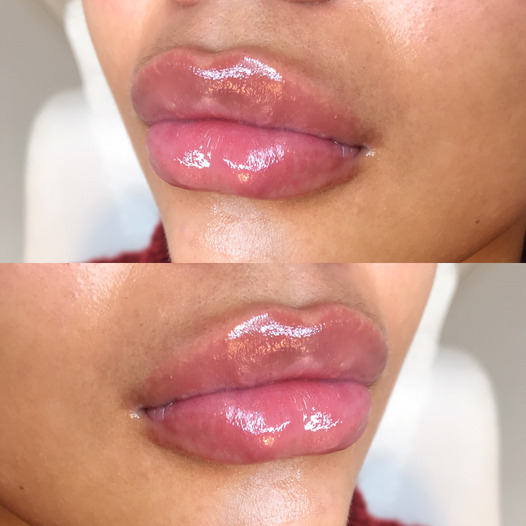 Dermal lip fillers in Bromley